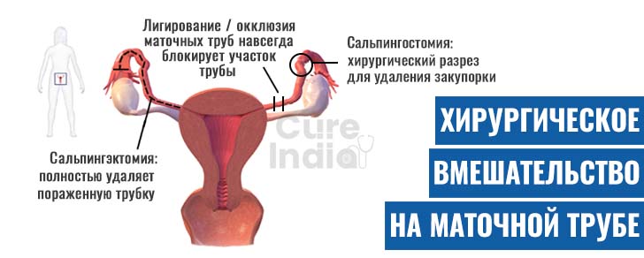 Хирургические процедуры на маточных трубах